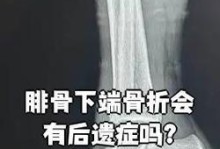 如何判断是否骨折？（识别骨折的关键指标和应急处理方法）