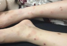 狗狗被跳蚤咬多久能治好？（了解治疗跳蚤咬伤的时间和方法）