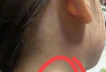 揭开脖子里的硬块之谜（探寻隐藏在脖子深处的神秘肿块）